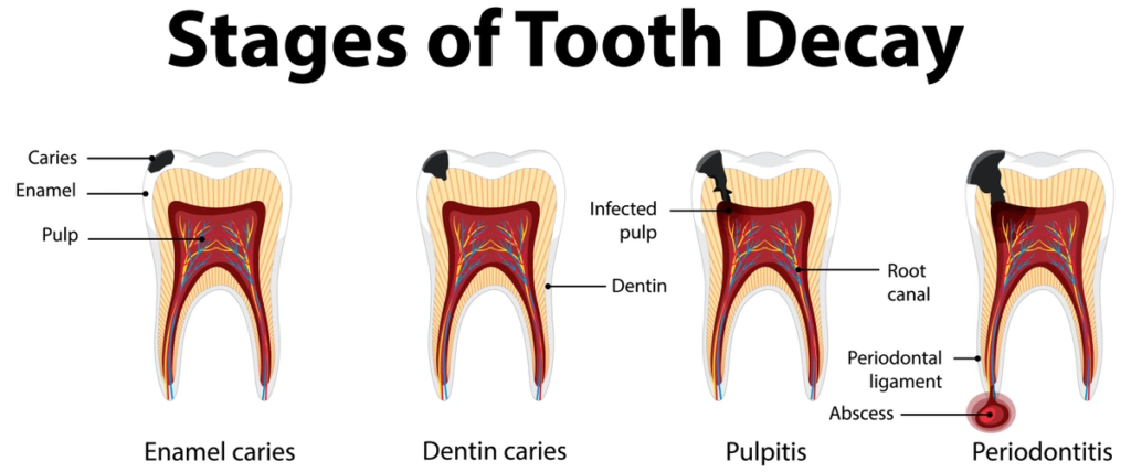 tooth-infections